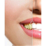 Professional Home Teeth Whitening Kit